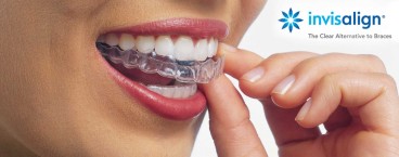 invisalign invisalign